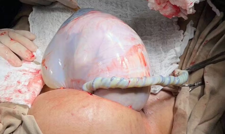 Bebê nasce envolto em bolsa amniótica
